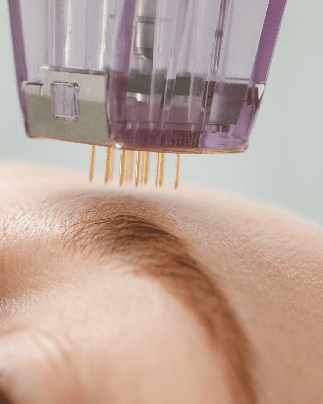 Micro needling