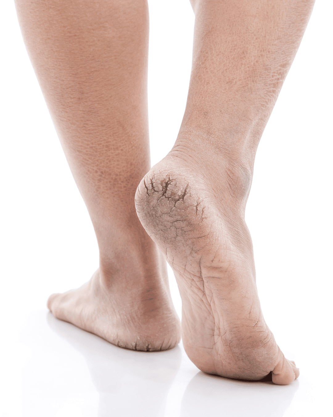 Cracked Heel Repair
