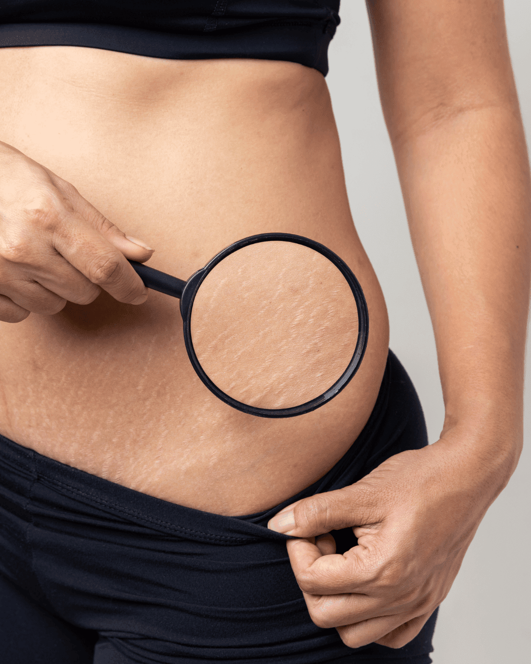 Stretch Mark Treatment