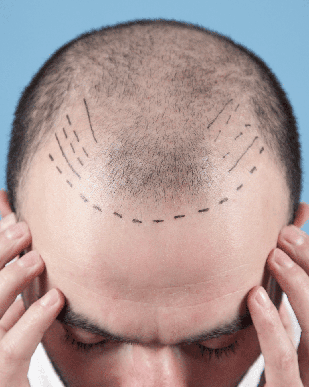 Hair Transplantation